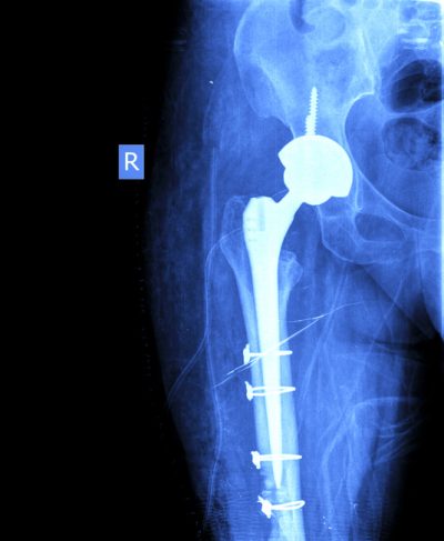 reprise prothese hanche